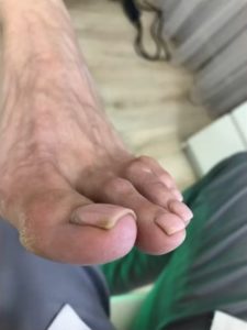 мозоль большого пальца