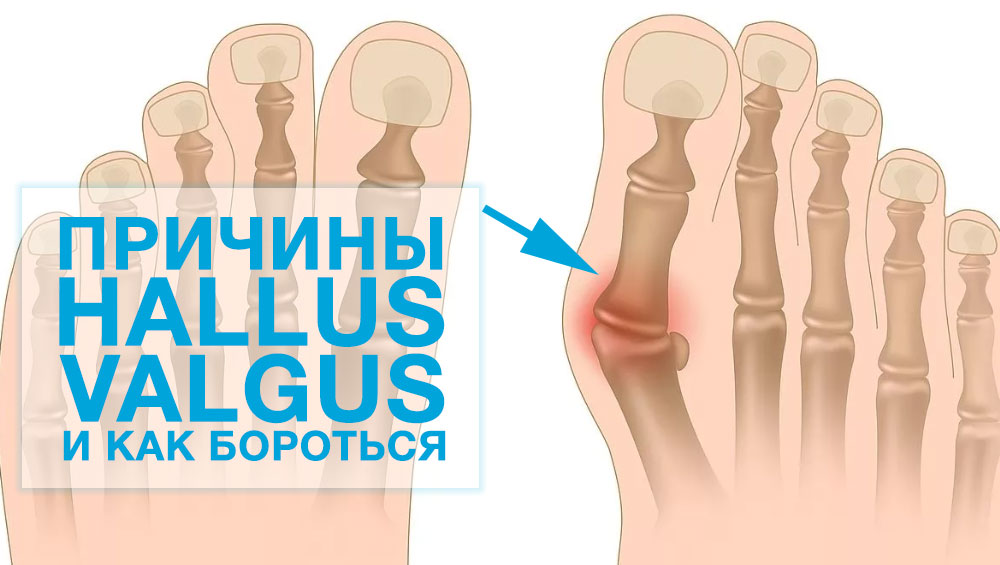 Hallus Valgus - причины появления и как бороться с ним